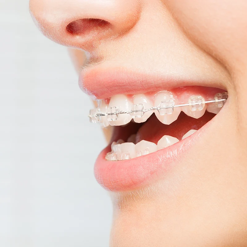 Feste Zahnspange Euskirchen