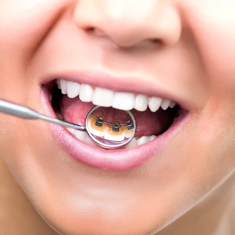 Lingualtechnik Innenanliegende Zahnspange